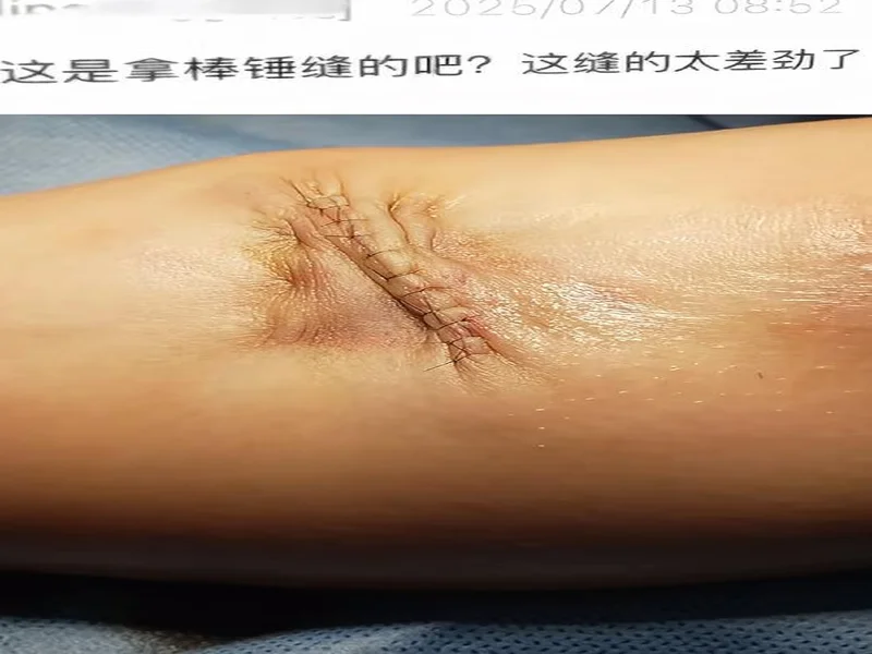 广州豹官方：杨浩眉弓伤口缝合30余针，预计5-7天后拆线